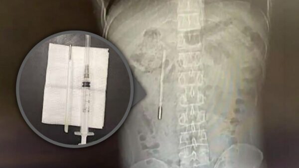 Đi viện vì đau dạ dày, người đàn ông bất ngờ phát hiện chiếc nhiệt kế thủy ngân nằm trong bụng suốt hai mươi năm